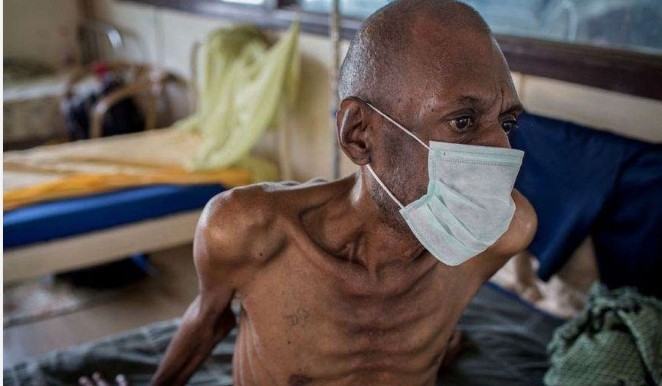 A Silent Killer, A Loud Call to Action: Commemorating World Tuberculosis Day and the Urgent Race to End TB